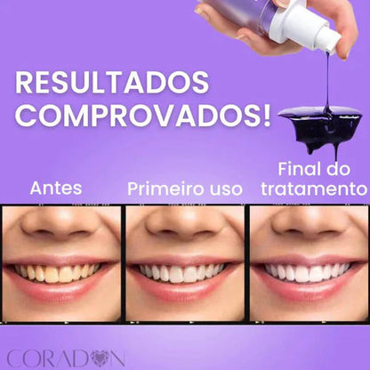 SmileEase - Clareador Mágico Dental | Transforme seu sorriso em poucos dias